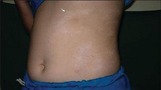 esclerodermia