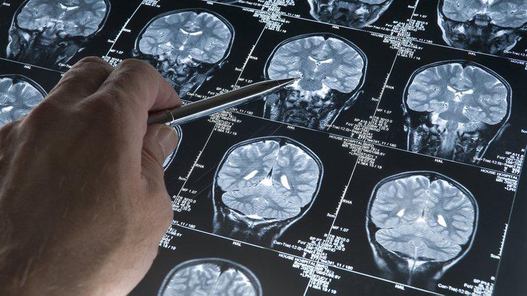 cerebro placa